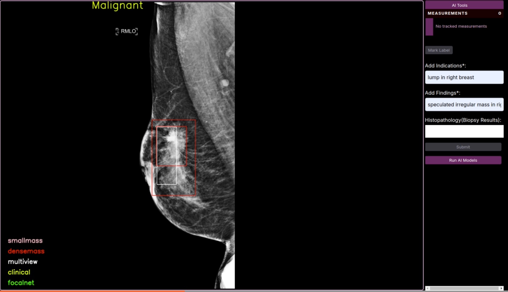 Breast Cancer