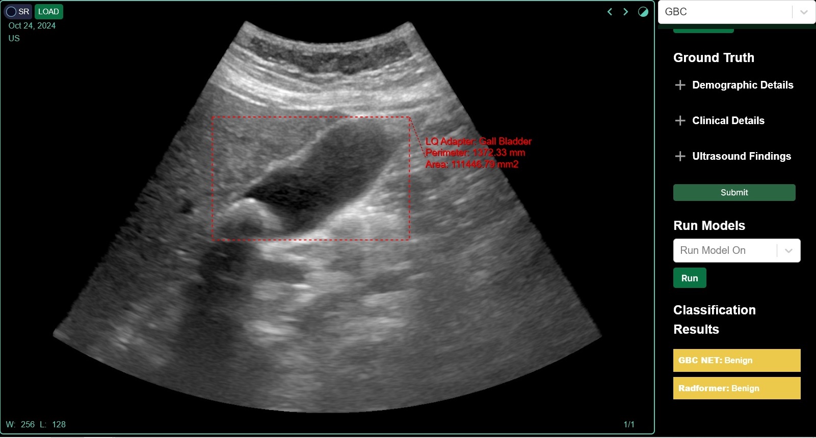 Gallbladder Cancer